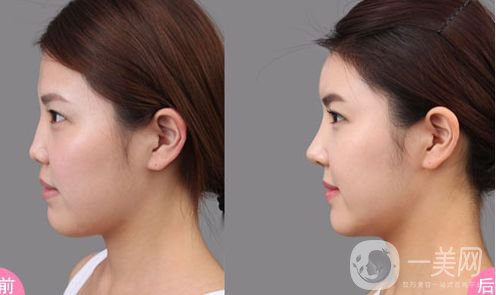 自體隆鼻價(jià)格是多少 *果好不好？