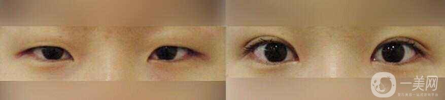 開(kāi)眼角有危險(xiǎn)嗎 開(kāi)眼角多少錢(qián)