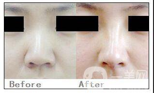 鼻小柱延長(zhǎng)價(jià)格,鼻小柱延長(zhǎng)*果