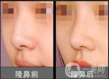 隆鼻手多少錢(qián),隆鼻貴不貴