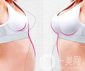 自體脂肪豐胸,自體脂肪豐胸術(shù)后護(hù)理