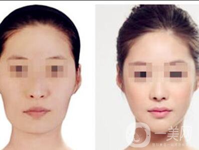 顴骨吸脂,顴骨吸脂注意事項