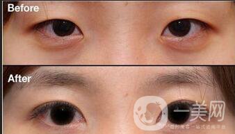 三點(diǎn)定位雙眼皮,全切,埋線