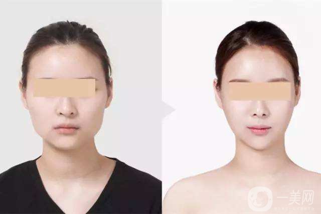 硅膠墊下巴報(bào)價(jià) 硅膠墊下巴材料