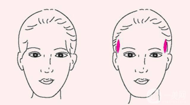 玻尿酸豐太陽穴報價 玻尿酸豐太陽穴的方法