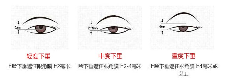 上瞼下垂矯治術(shù)*果怎么做 保持多久？