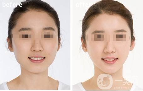 *能維持多長時(shí)間 注射*注意事項(xiàng)