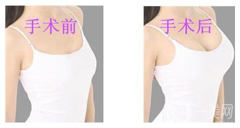 假體隆胸的恢復(fù)時(shí)間是多久？