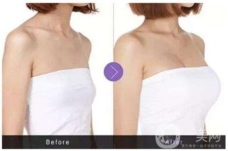 隆胸選擇哪種材料*好？隆胸醫(yī)生教你選擇！