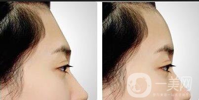 膨體豐額頭, 膨體豐額頭價(jià)格