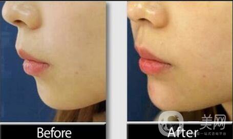 下巴注射玻尿酸,注射玻尿酸術(shù)后注意事項