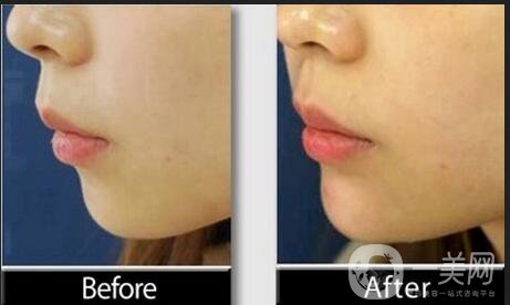 玻尿酸墊下巴注意事項(xiàng)
