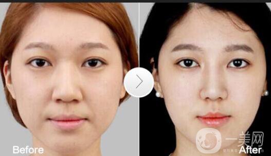 鼻翼縮小多少錢(qián),鼻翼縮小術(shù)后護(hù)理