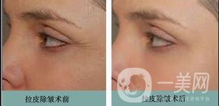 拉皮手術(shù)多久恢復(fù),拉皮手術(shù)注意事項(xiàng)