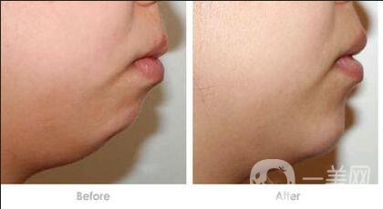 下巴吸脂多久恢復(fù),下巴吸脂術(shù)后護(hù)理方式
