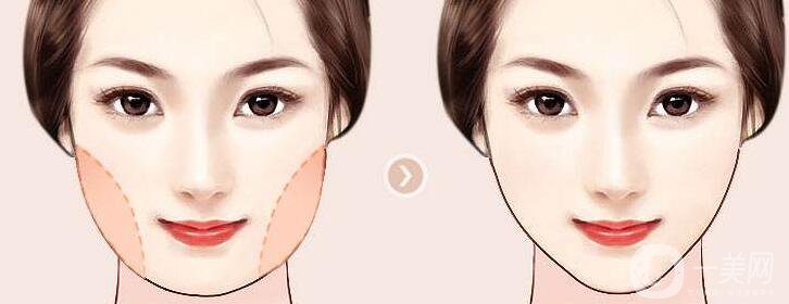 吸脂瘦臉手術(shù)大概多少錢 吸脂瘦臉有風(fēng)險(xiǎn)嗎