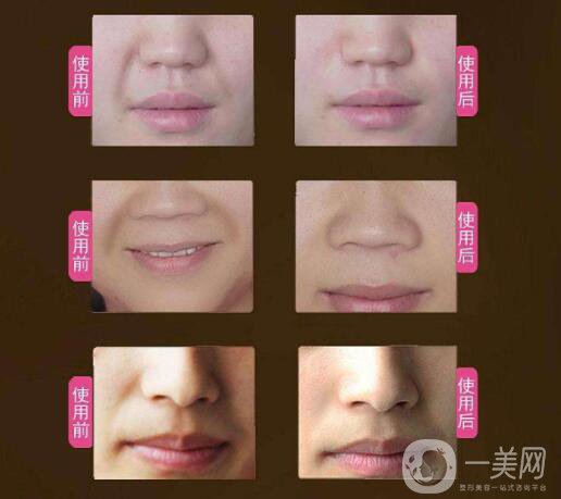 玻尿酸去法令紋的價錢 時間保持久嗎？