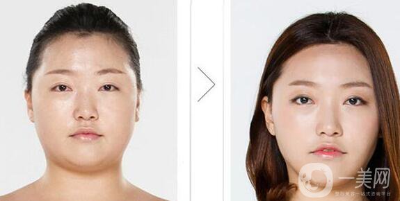 深圳臉部溶脂多少錢 臉部溶脂的好處