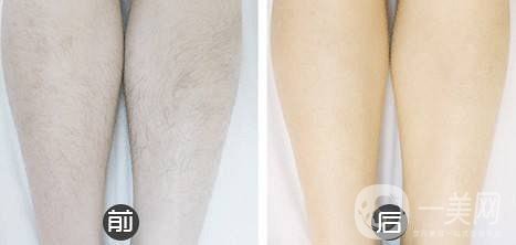 *性脫毛的價格 脫毛的方法