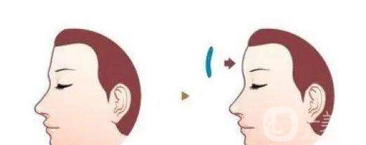 硅膠豐額頭貴嗎 硅膠豐額頭材料有哪些？