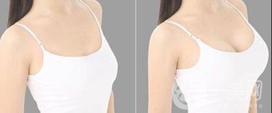 假體豐胸手術(shù)費用,假體豐胸多少錢