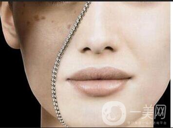 激光祛除黃褐斑*果,激光祛除黃褐斑注意事項