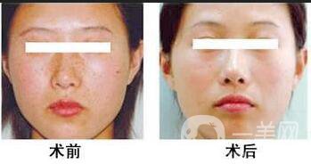 復(fù)合彩光調(diào)節(jié)*果,復(fù)合彩光調(diào)節(jié)禁忌人群