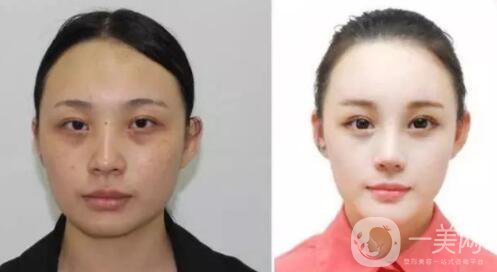 光子嫩膚的優(yōu)勢 光子嫩膚有風險嗎？