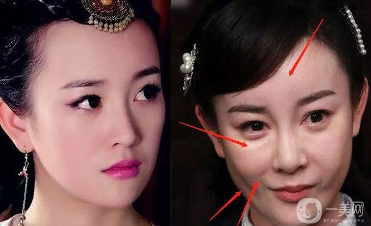 明星整容就是不承認？ 然后突然臉“爛”了！