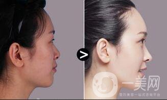 伊維蘭注射隆鼻,伊維蘭注射隆鼻*果,伊維蘭注射隆鼻*果保持多久