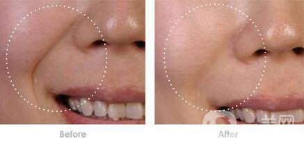 自體脂肪豐鼻唇溝