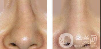 歪鼻矯正多少錢,歪鼻矯正注意事項