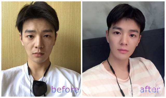 自體脂肪可以填充淚溝嗎？手術(shù)*果好不好？