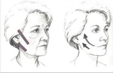 熱瑪吉除皺價(jià)格是多少錢(qián) 熱瑪吉*果怎么樣