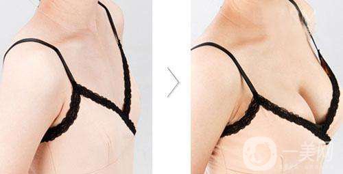 假體豐胸多久才不會(huì)硬 多久會(huì)變軟？