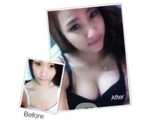 假體豐胸術(shù)前準(zhǔn)備 假體隆胸材料有哪些