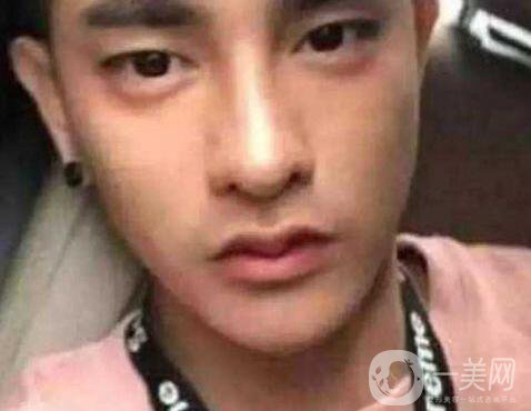 小伙整容數(shù)十次，只為一張韓星臉