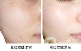 黑臉娃娃,副作用