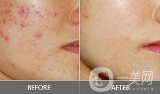 像素激光祛痘坑*果,像素激光祛痘坑術后護理