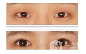 開眼角風(fēng)險(xiǎn)