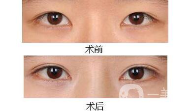 高分子割雙眼皮維持多長(zhǎng)時(shí)間,高分子割雙眼皮注意事項(xiàng)