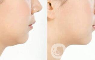 光纖溶脂瘦臉*果