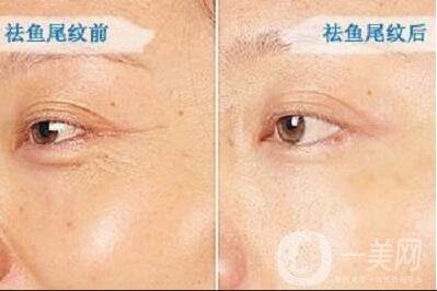 伊維蘭注射除皺多少錢