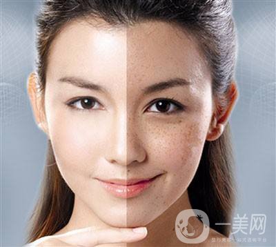 c6激光祛斑多少錢(qián) 激光祛斑*果怎么樣