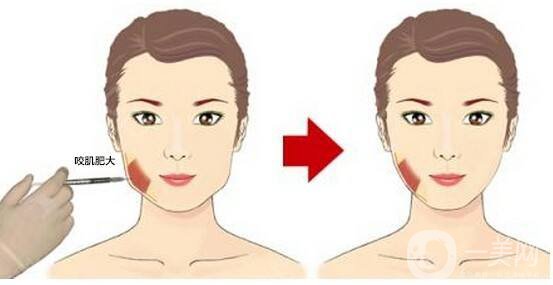 切咬肌多少錢 瘦臉的方法