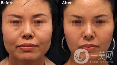 電波拉皮維持時間