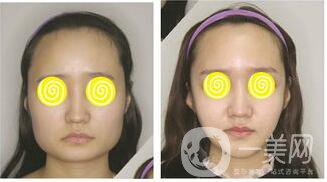 削骨瘦臉多少錢(qián),削骨瘦臉*果