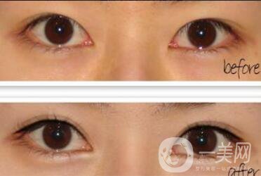 什么人適合開眼角,開眼角注意什么