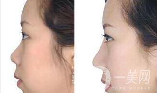 深圳縮鼻頭多少錢,縮鼻頭價(jià)格