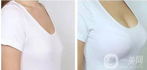 假體隆胸多久可以抽煙 假體隆胸術(shù)后注意事項(xiàng)